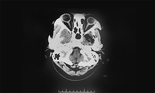 面麻是怎么引起的,面麻痛