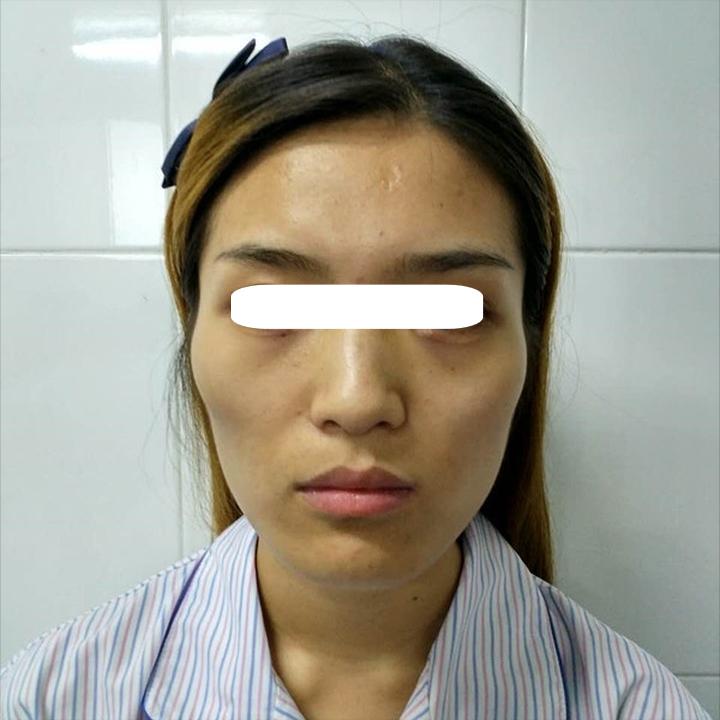 明星为啥要做脂肪填充鼻子,为什么明星喜欢整容