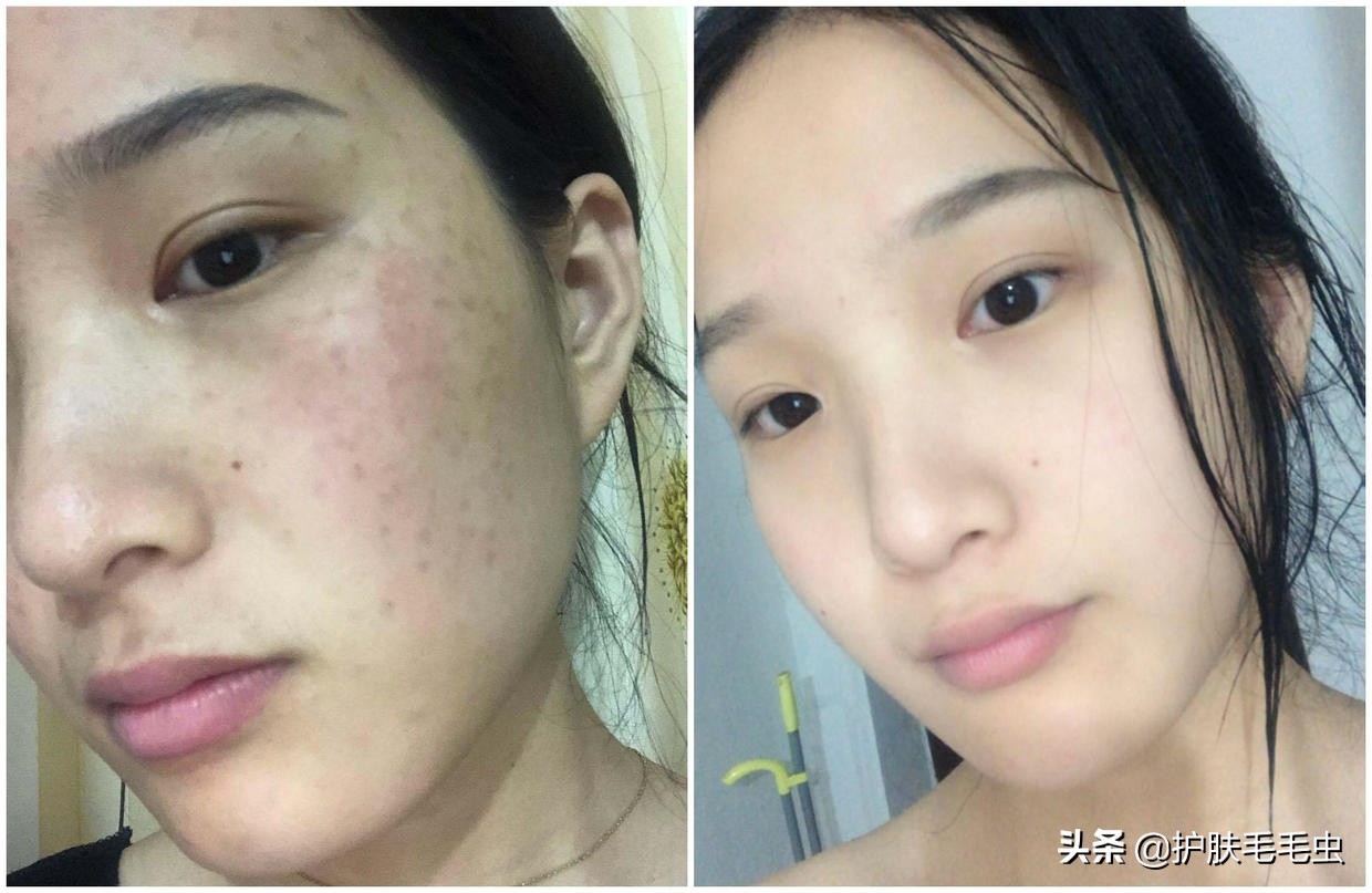 脸颊两侧长斑了怎么快速去除,脸颊两侧长斑的原因和治疗方法