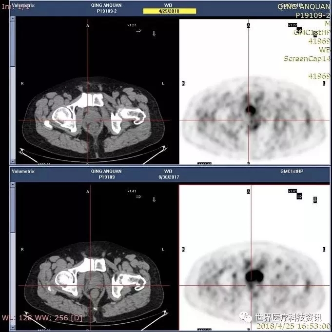 疟原虫治疗癌症叫停,疟原虫治疗癌症最新消息
