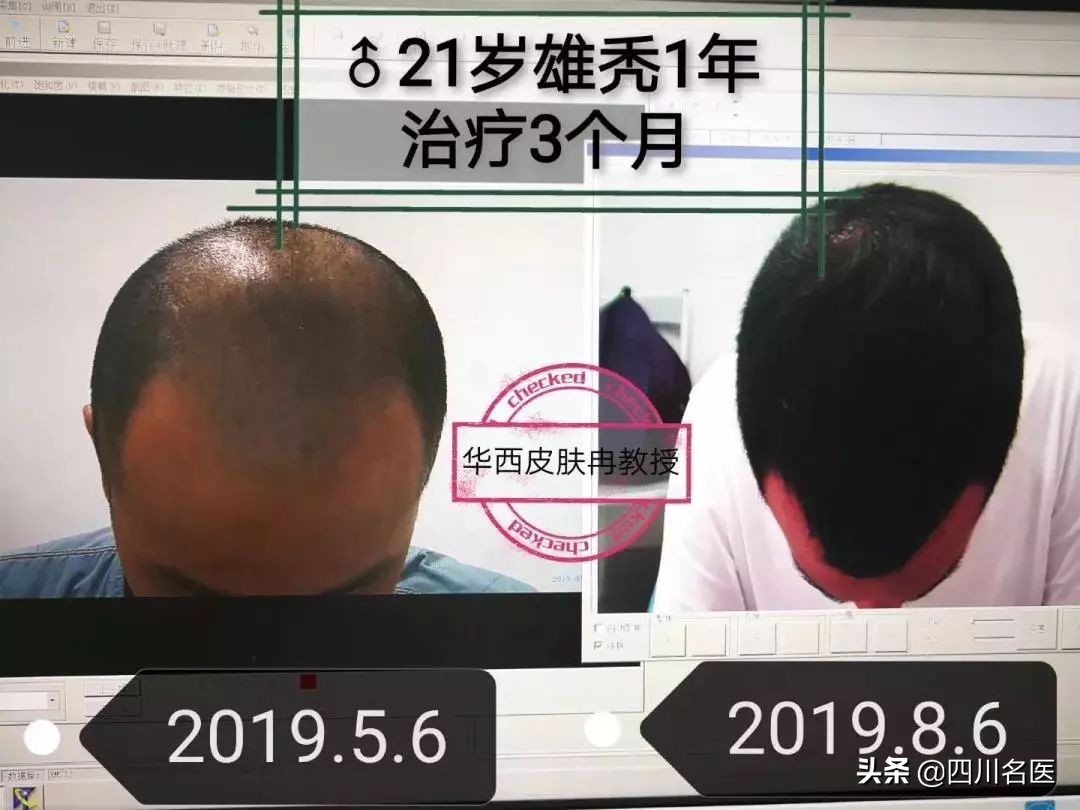 成都华西医院治疗脱发最老的医生,华西的皮肤科治疗脱发吗