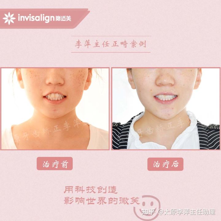 太原整牙齿矫正要多少钱,坏牙齿只剩牙根有必要拔牙吗