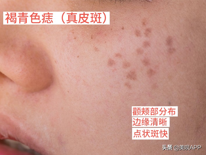 脸上有斑怎么祛斑最快最有效,脸上长斑点用什么药才能祛斑