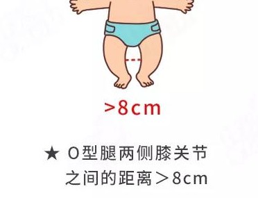 髋关节发育不对称怎么办,腿纹不对称髋关节发育不良