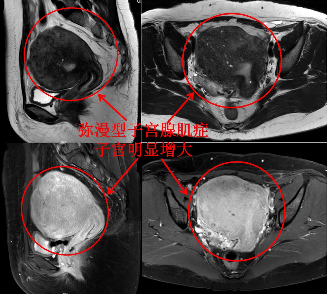 子宫腺肌症痛经中医能治好吗,子宫腺肌症引起的痛经艾灸哪里