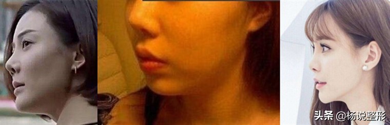 六种常见的失败隆鼻手术,隆鼻怎么预防鼻头越来越尖