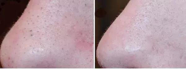 蜂蜜加白醋有哪些用途,白醋加蜂蜜真有这么好吗