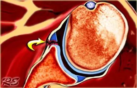 所有骨折都叫什么名字,骨折的名称有哪些