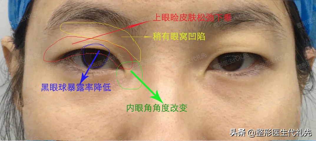 年轻时精致的单眼皮,过了30岁松弛变形,如何进行眼睛美丽年轻化