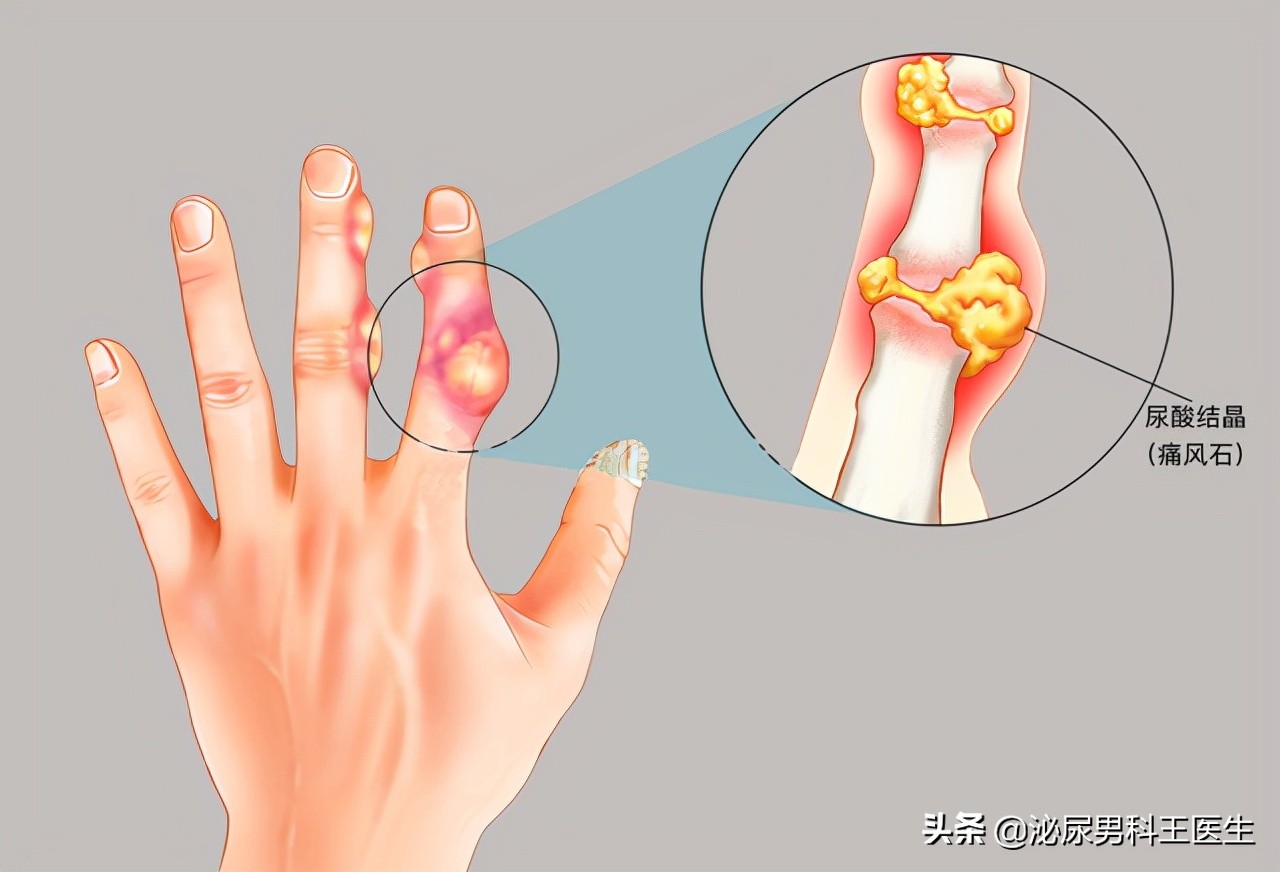 尿酸高身体会出现哪些症状,尿酸高怎么调理下来还需要吃药