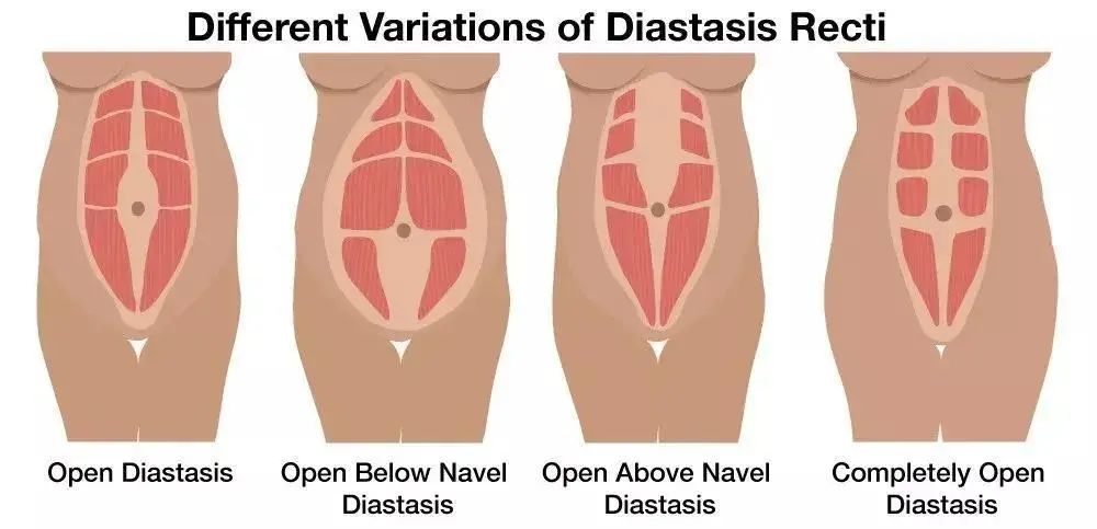 产后肚子胀不排气怎么办,产后两年肚子大如何修复