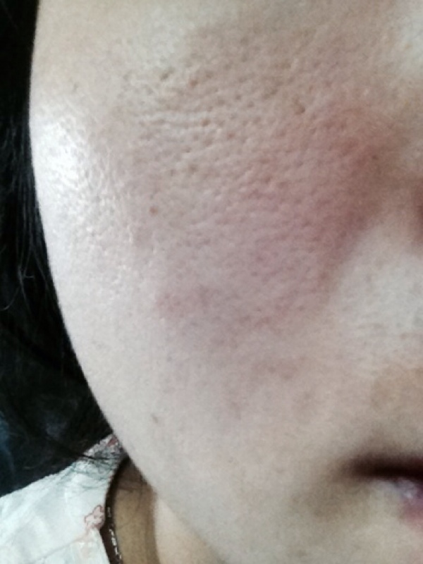 郭鸿财：皮肤毛孔粗大，影响着脸部的美观，这个该怎么改善呢？