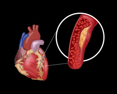 冠心病患者既不能做支架也不能做搭桥怎么办？