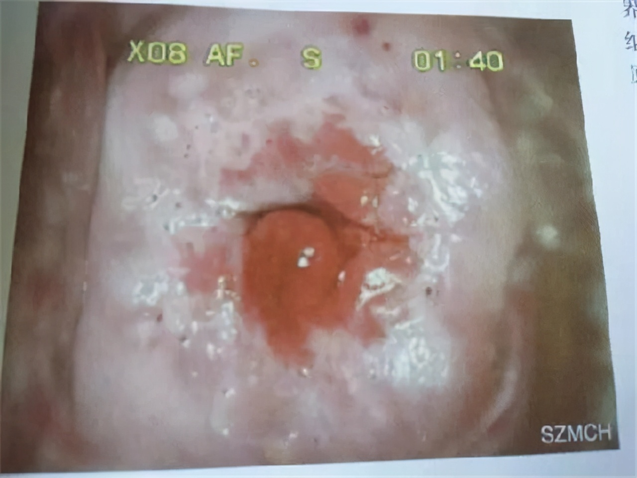 28岁女博士查出宫颈癌，平时洁身自好，医生提醒：这1件事要注意