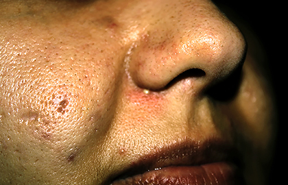 缩小毛孔的最有效方法是什么,缩小毛孔最有效的方法是什么