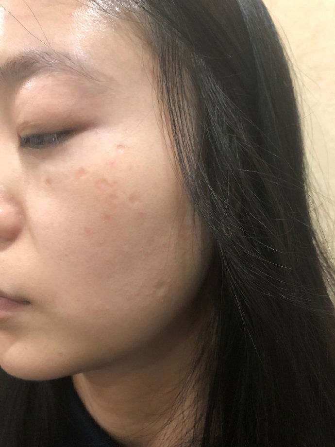 点阵激光能把伤疤完全修复吗,激光点阵可以修复到多少程度