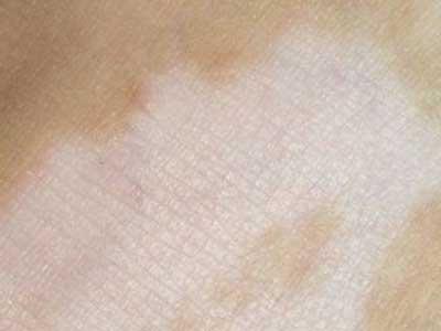 白癜风治疗之308nm准分子激光会出现的情况