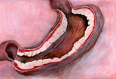 胃癌病理活检找不到癌细胞怎么办,胃壁增厚胃镜能看出来吗