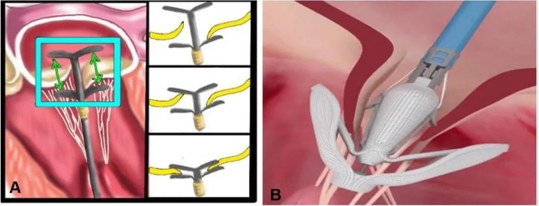 心脏“小门”关不严,经导管二尖瓣介入治疗,不开胸就换瓣