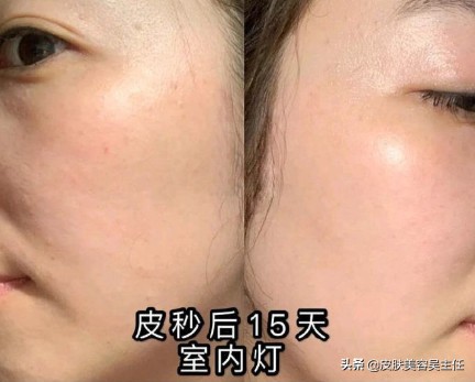 激光可以彻底祛斑吗多少钱,激光祛斑做几次彻底去掉斑