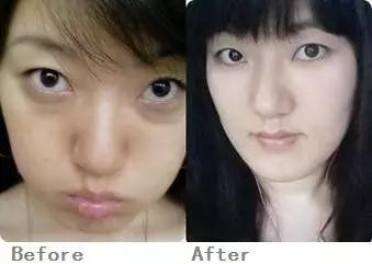 有眼袋的直观感受,眼袋真实案例分享