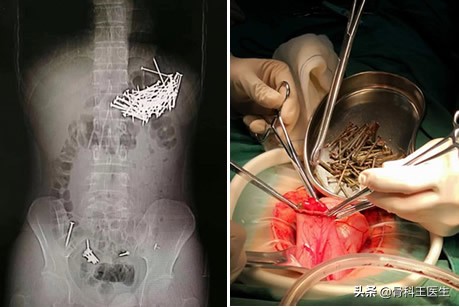 医院取出的异物怎么处理,医生都从患者体内取出过什么异物