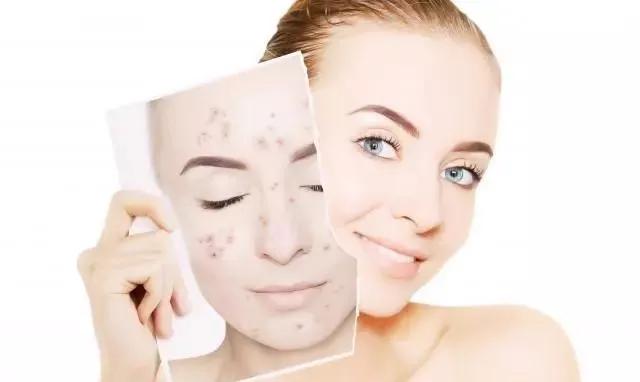 红色痘印和黑色痘印哪个严重,红色痘印和黑色痘印