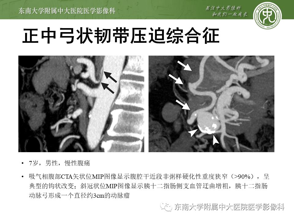 肠系膜上动脉压迫综合征挂什么科,肠系膜上动脉压迫综合征手术费用