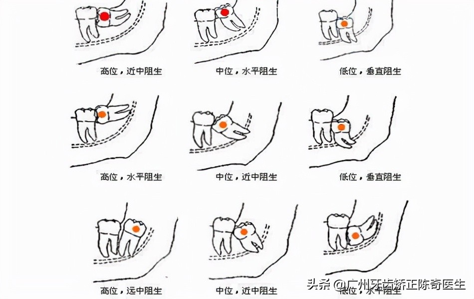智齿发炎有脓是否需要切开,智齿反复发炎不去拔掉的后果