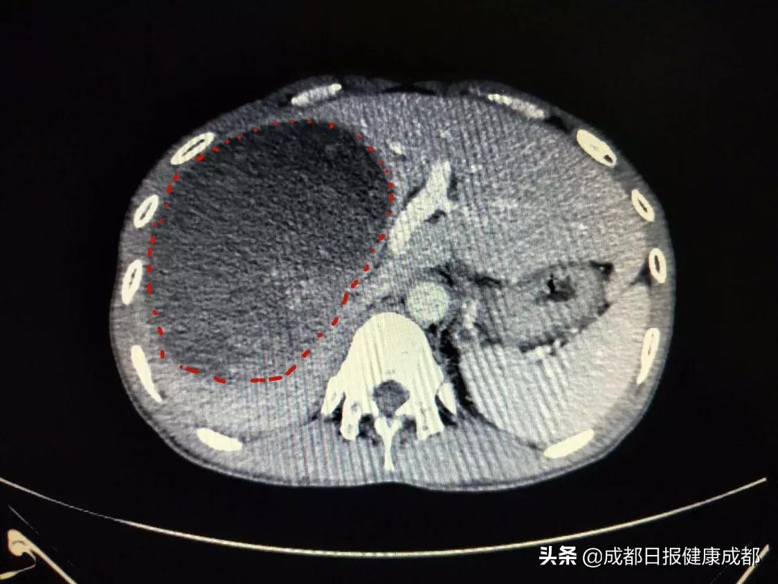 肝脏长15厘米肿瘤,肝脏肿瘤15mm手术后能根治吗