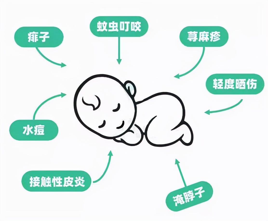 儿童能擦的止痒药膏,小孩皮肤瘙痒能用炉甘石洗剂吗