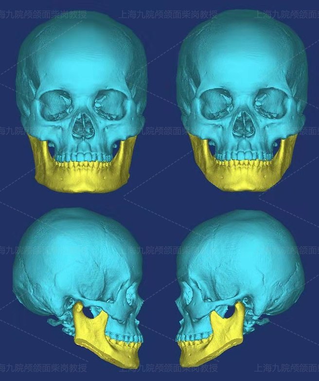 颧骨下颌角手术十天,颧骨宽可以做什么手术