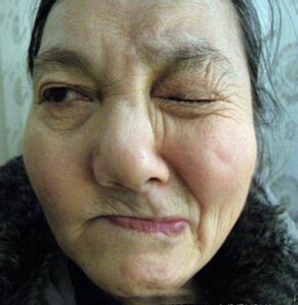 眼跳神经痉挛针灸,继发性的面肌痉挛好治疗