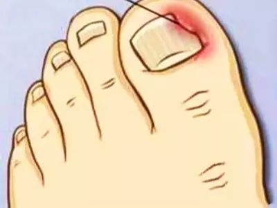 甲沟炎怎么自己修剪,甲沟炎修剪过程怎么缓解疼痛