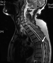 脊髓压迫骨髓,压迫脊髓必须做手术吗