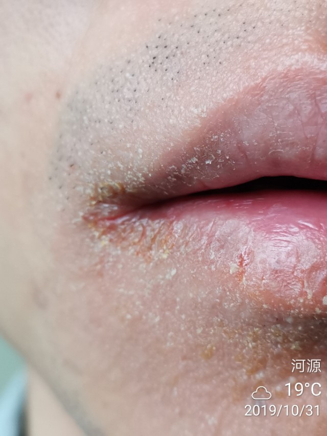 冬季多发口角炎（烂嘴角），中医怎么治？