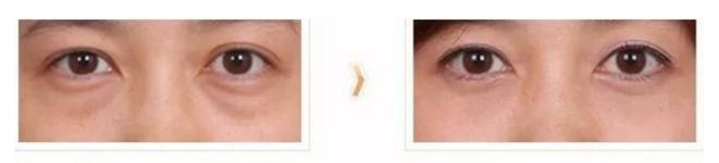 眼袋显老10岁三种方法帮助改善,眼袋显老怎么解决