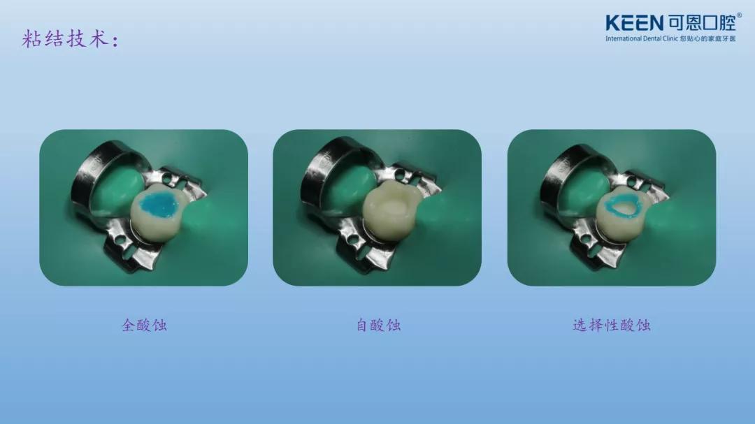 可恩口腔集团举办《树脂充填+粘接》培训班