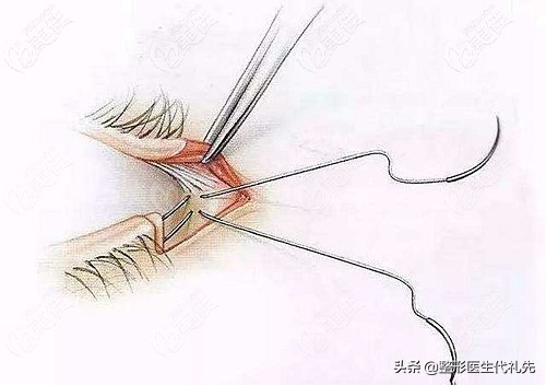 医美专家聊整形知到答案,整形医生谈去黑眼圈