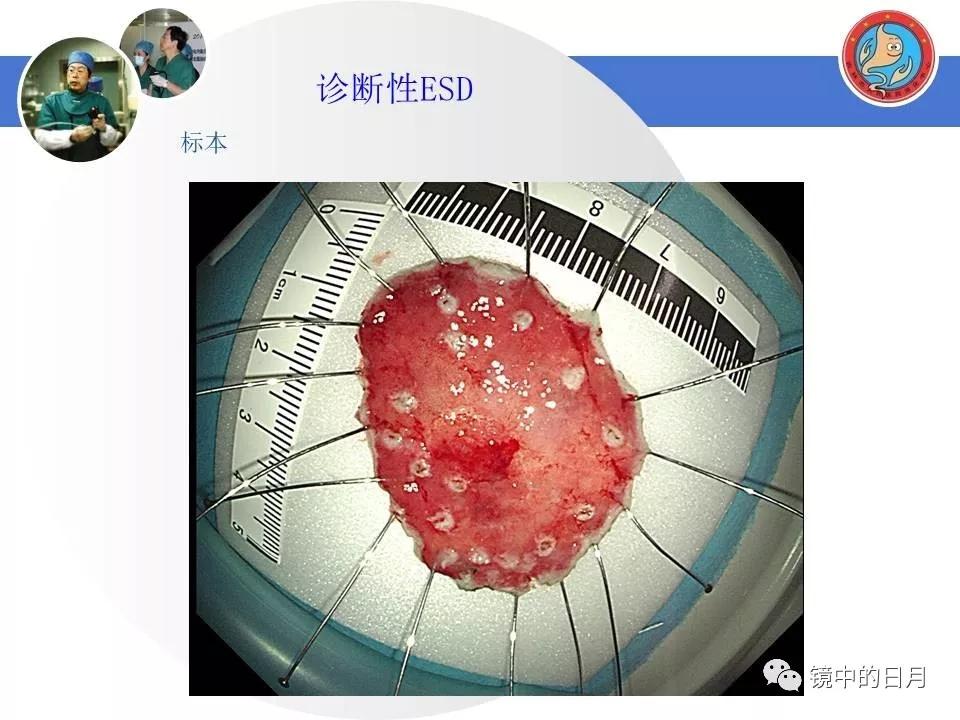 低分化胃癌早期时候做内镜手术吗,早期胃癌内镜手术后追加外科手术