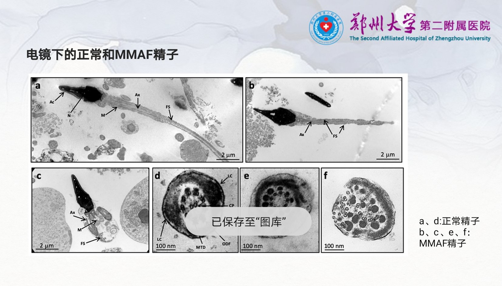 严重弱精症和完全无活动精子的原因是啥？