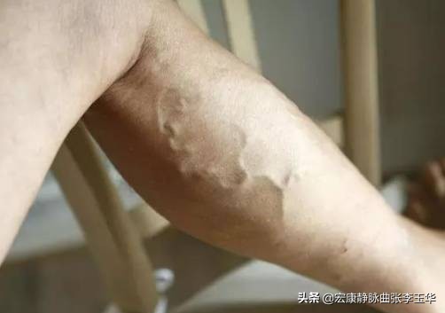 血管变粗就是静脉曲张？你了解的静脉曲张是怎样的？