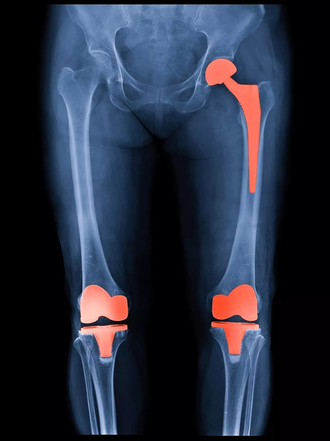 膝盖关节炎腿疼有什么好的方法吗,膝盖关节炎有骨刺怎么治疗