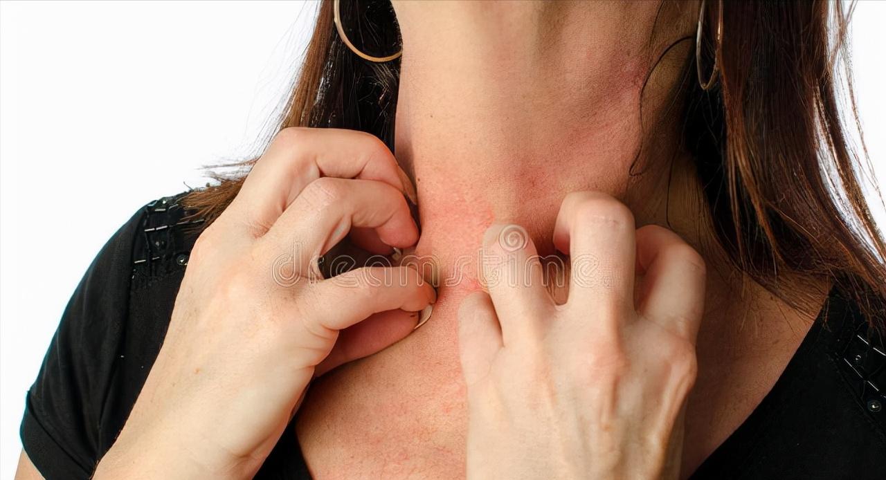 *麻疹荨**患者的饮食禁忌！并不是永久忌口，只是暂时不能吃