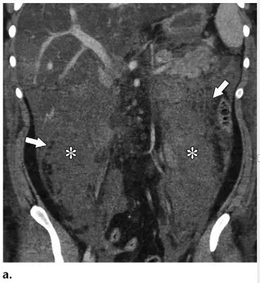 简述急性胰腺炎影像学表现,有关急性胰腺炎疼痛的图片