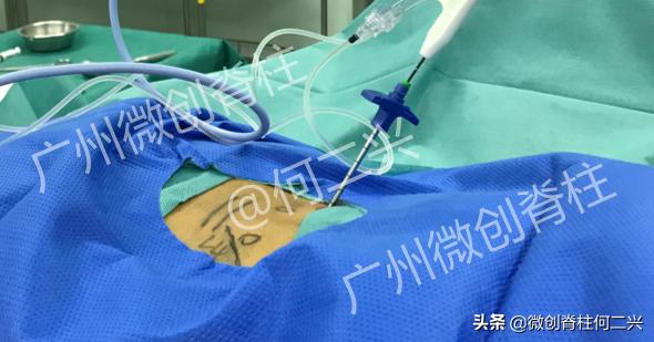 精准微创治疗案例：针尖上的技术——微波消融治疗脊柱转移性肿瘤