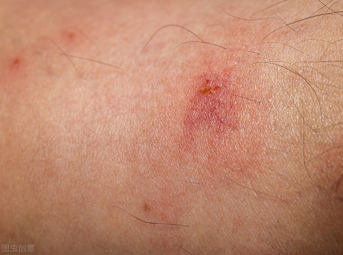 洪涝后经常出现的皮肤病是什么,洪灾后疾病预防