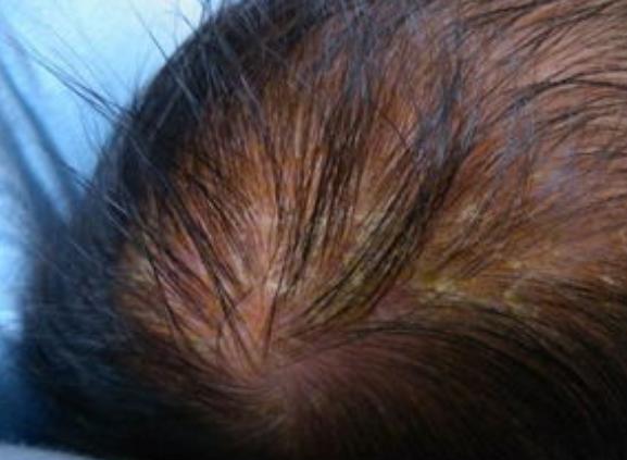 宝妈用手给婴儿抠头垢,宝妈不小心戳到宝宝鼻翼了