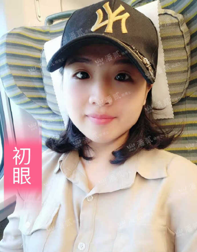 双眼皮手术后眼神凶狠是什么原因,双眼皮手术后显凶