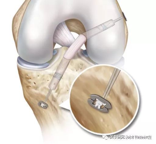 前交叉韧带断裂为什么没评上伤残,前交叉韧带断裂有什么症状
